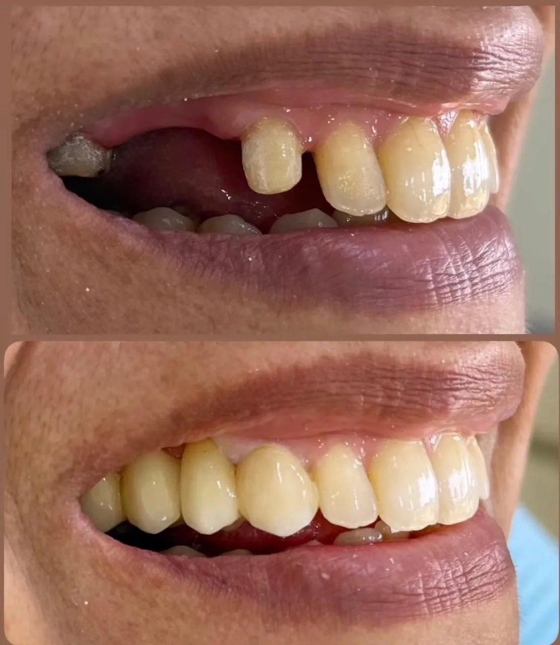 Avant / après : remplacement d'une dent manquante par implant